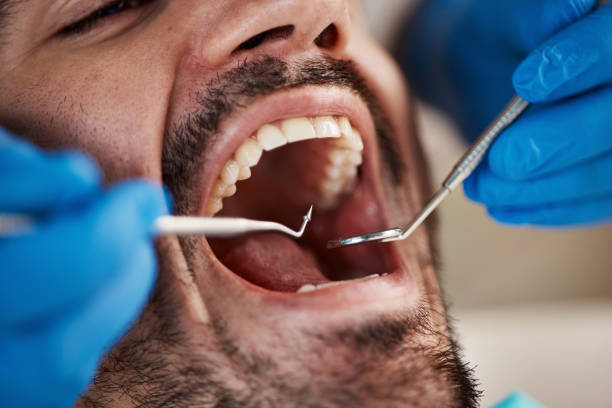 Best Broken or Cracked Tooth Emergency Dentist in Fairmount, IN